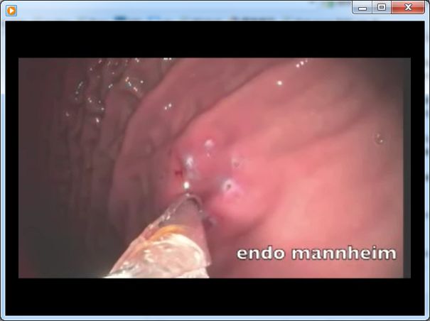 Video-Transgastric-access-to-the-abdominal-cavity